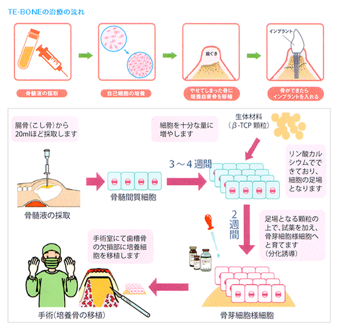 TE-BONEの治療の流れの図
