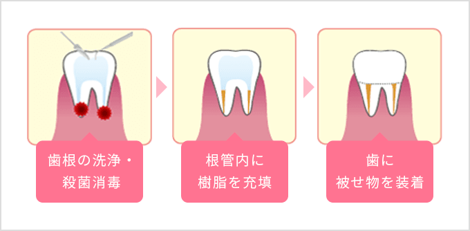 歯根の洗浄・殺菌消毒 根管内に樹脂を充填 歯に被せ物を装着