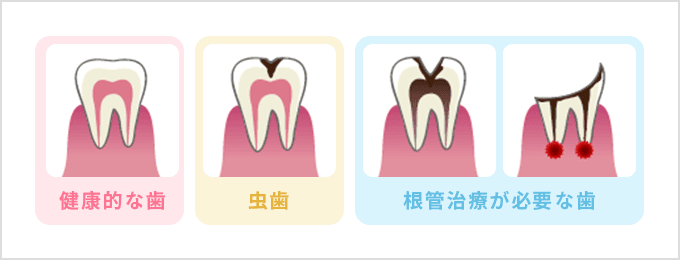 健康的な歯 虫歯 根管治療が必要な歯