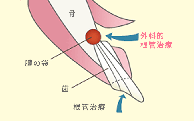 外科的根管治療骨膿の袋歯根管治療