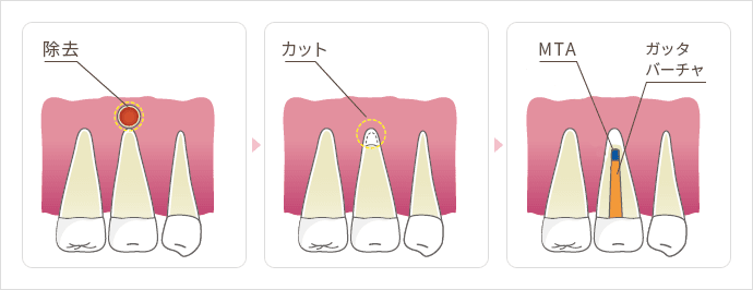 除去 カット MTA ガッタバーチャ