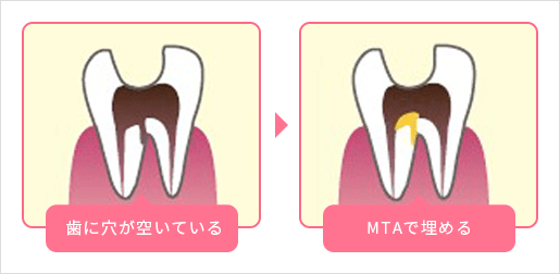 歯に穴が開いている MTAで埋める